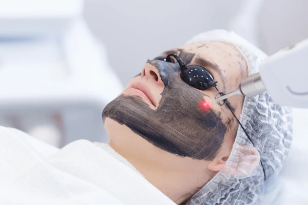 Carbon Laser.webp